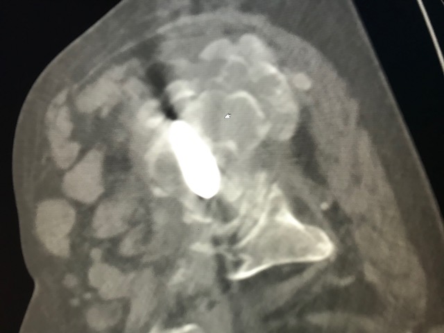 Figure 2 for case Tumoral calcinosis ( RID5202 )